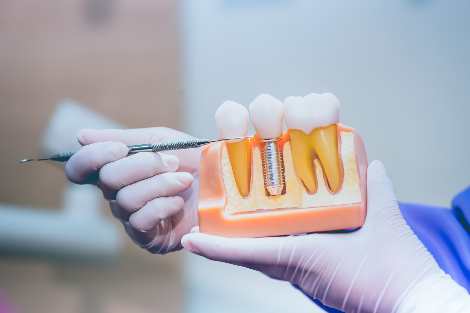Dentist holding a dental implant model showing the titanium post and crown