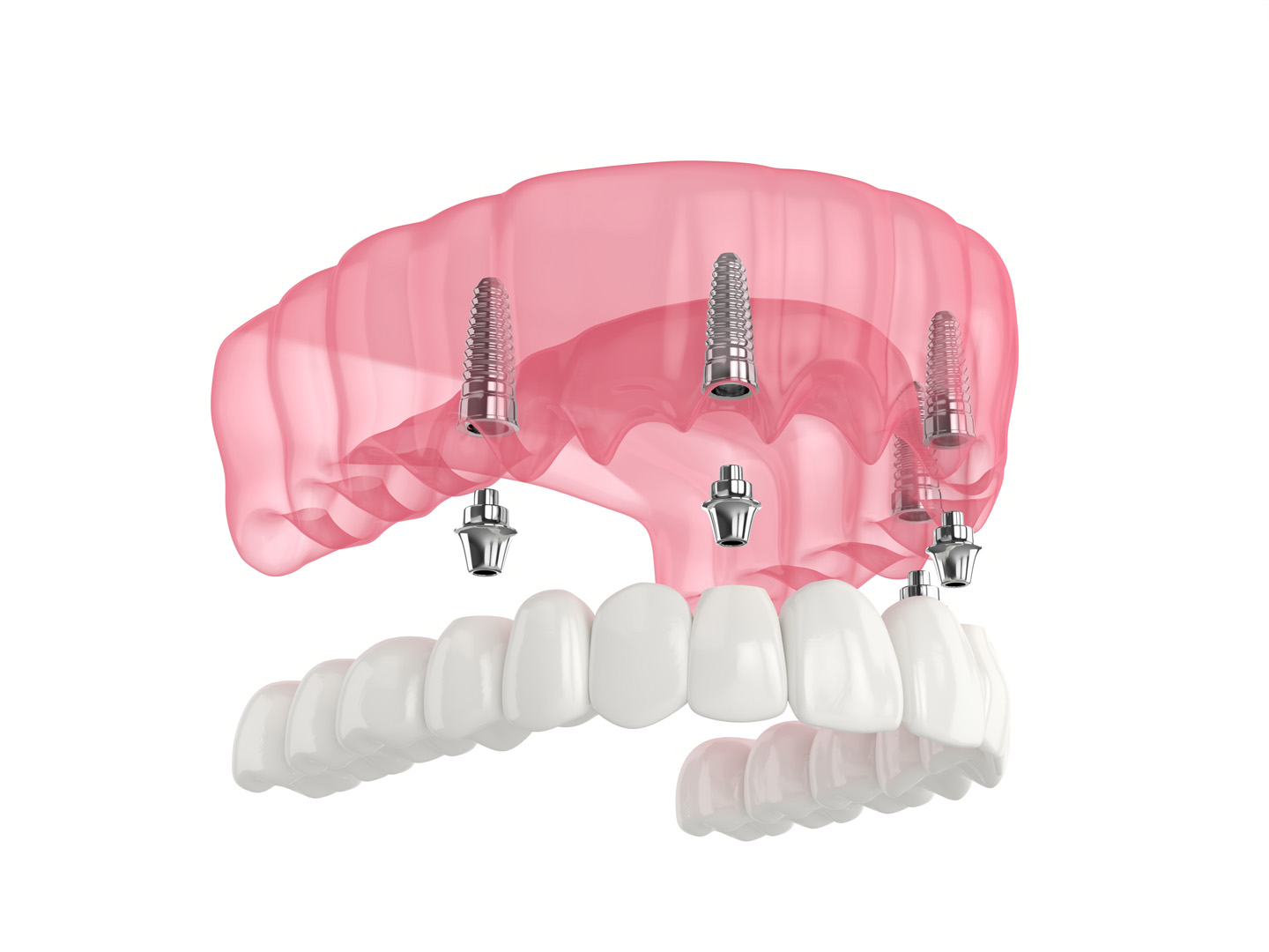 Mandibular prosthesis all-on-4 implant system supported by four titanium posts