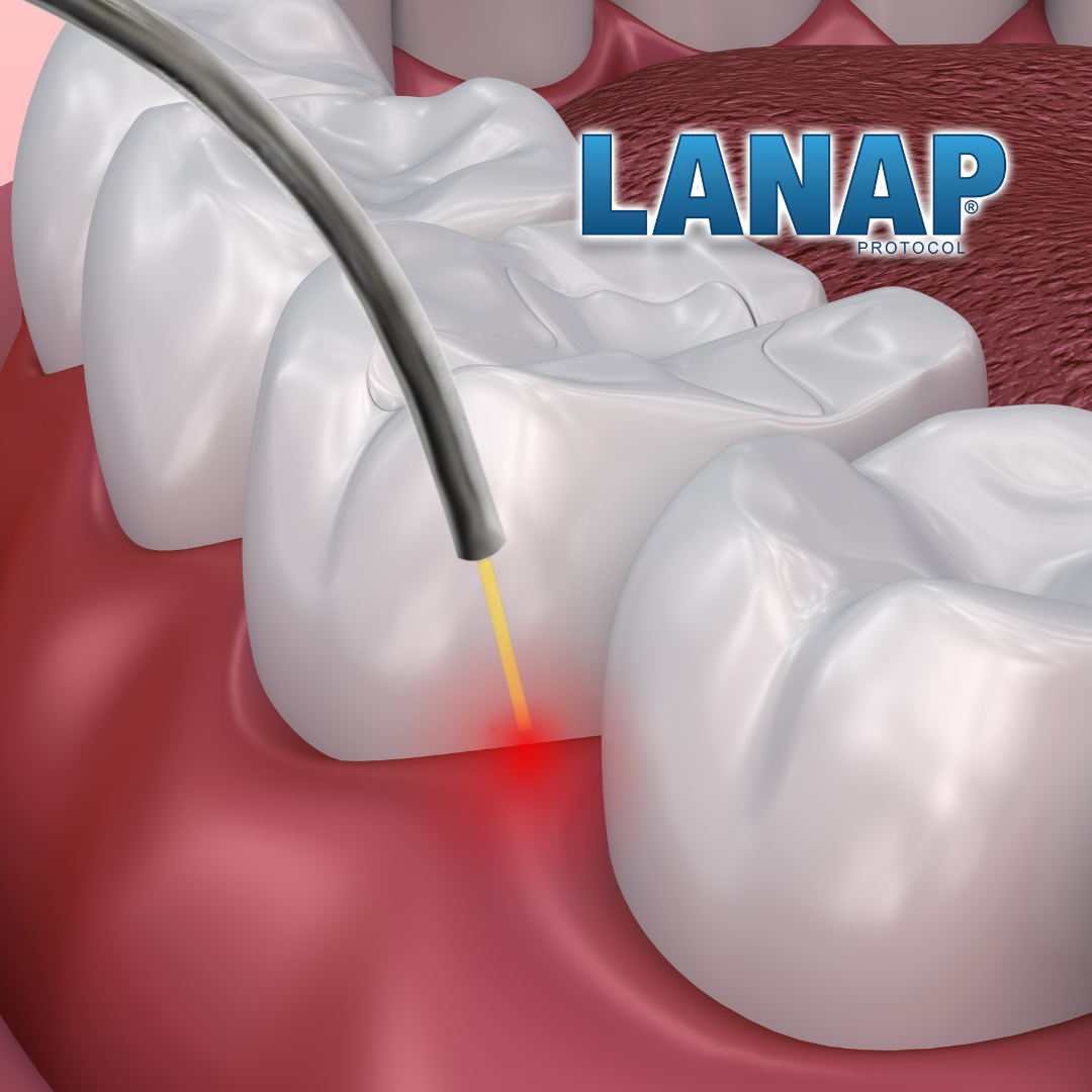 LANAP laser gum surgery procedure illustration