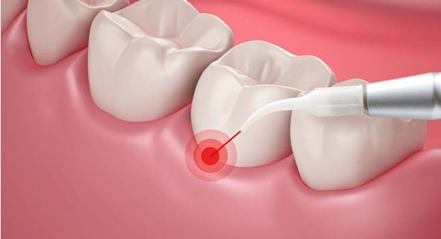 Laser pocket disinfection procedure at Periodontal Specialists of Hawaii
