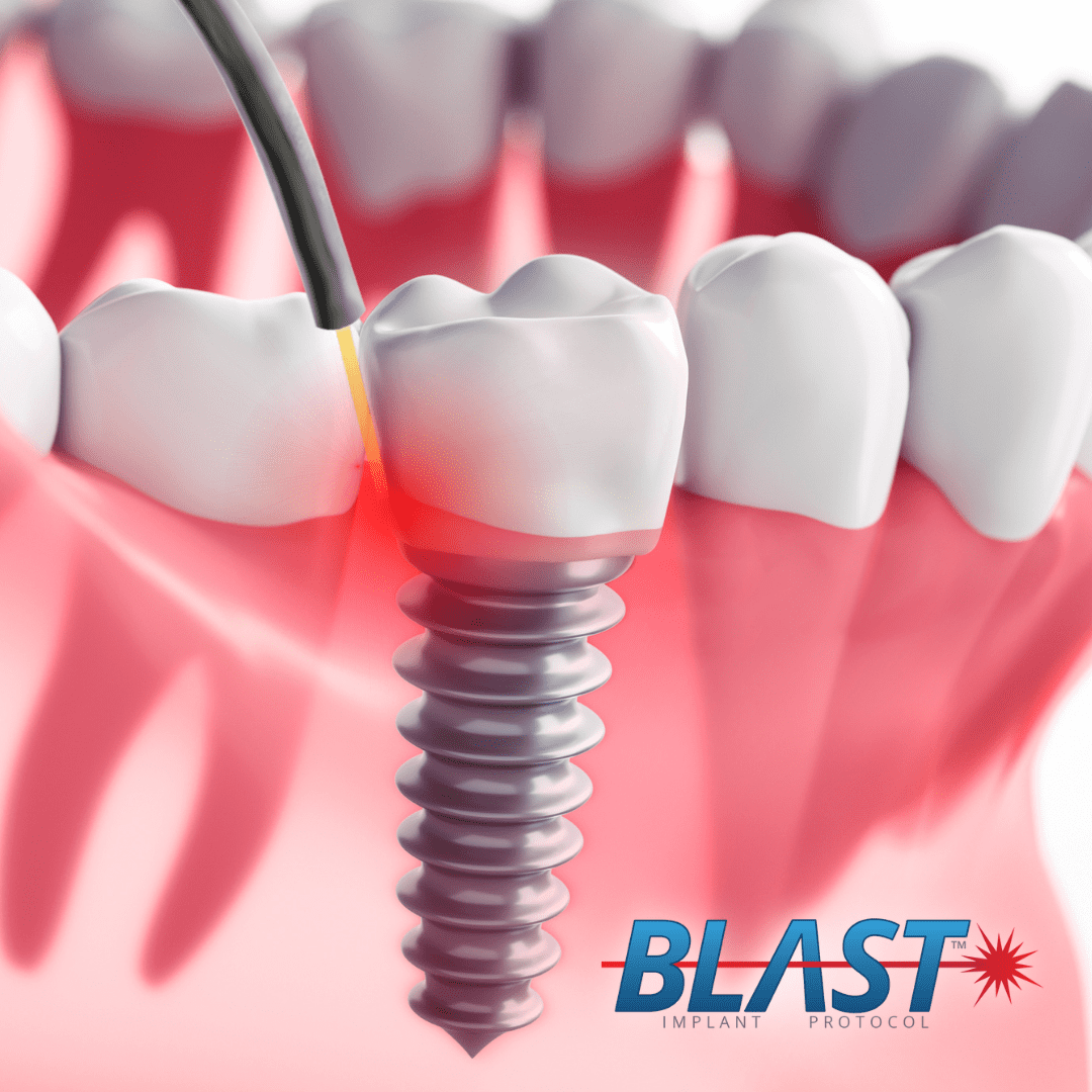 Advanced Blast Protocol dental implant treatment at Periodontal Specialists of Hawaii
