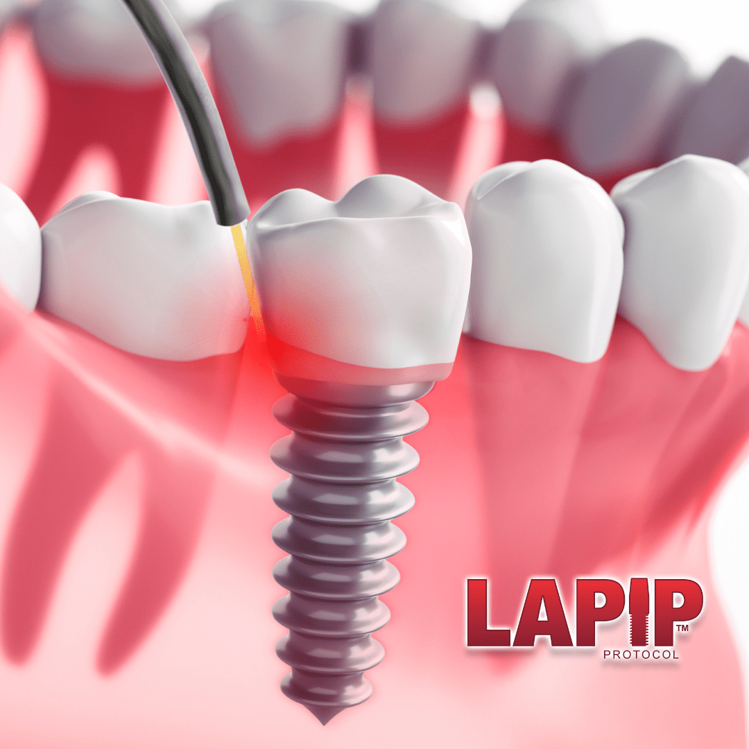 Dental implant with crown illustrating LAPIP peri-implantitis treatment